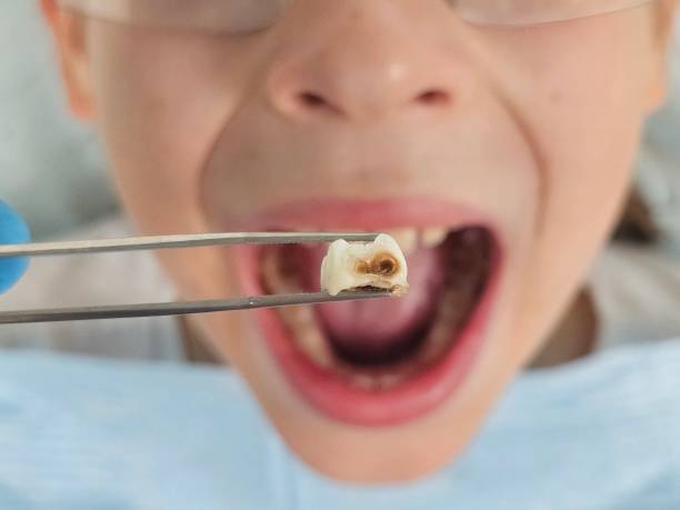 Best Emergency Wisdom Teeth Removal in Johnstown, CO